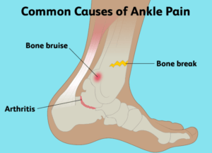 causes of ankle pain